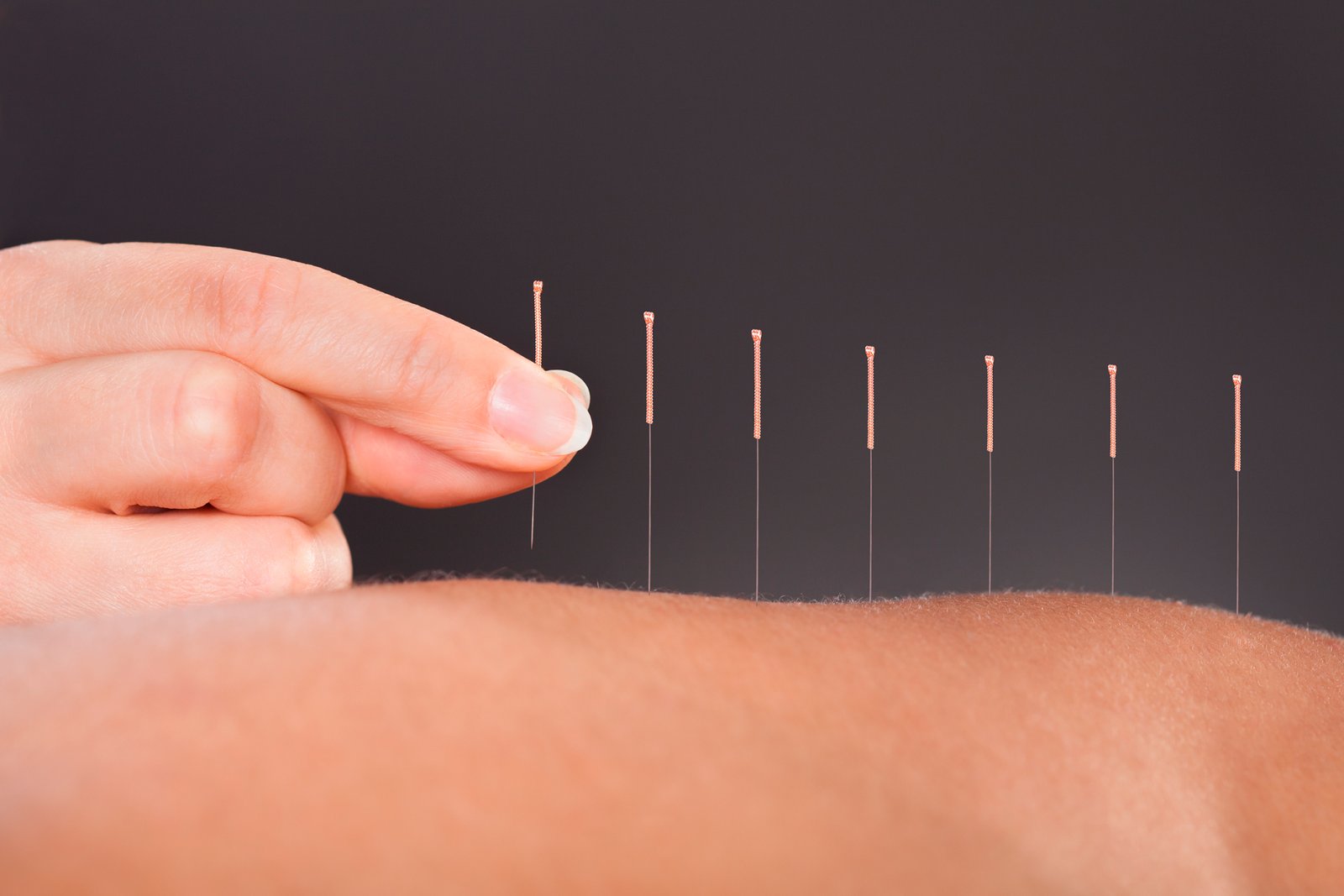 Acupuntura clínica en Calmavida